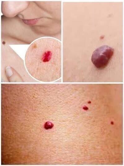 If you notice small red dots on your skin, they can signal many things, from harmless cherry angiomas and irritation to heat rash or allergies. Rarely, sudden spreading spots may suggest infection or bleeding issues—check with a healthcare professional promptly. ❤️🩺