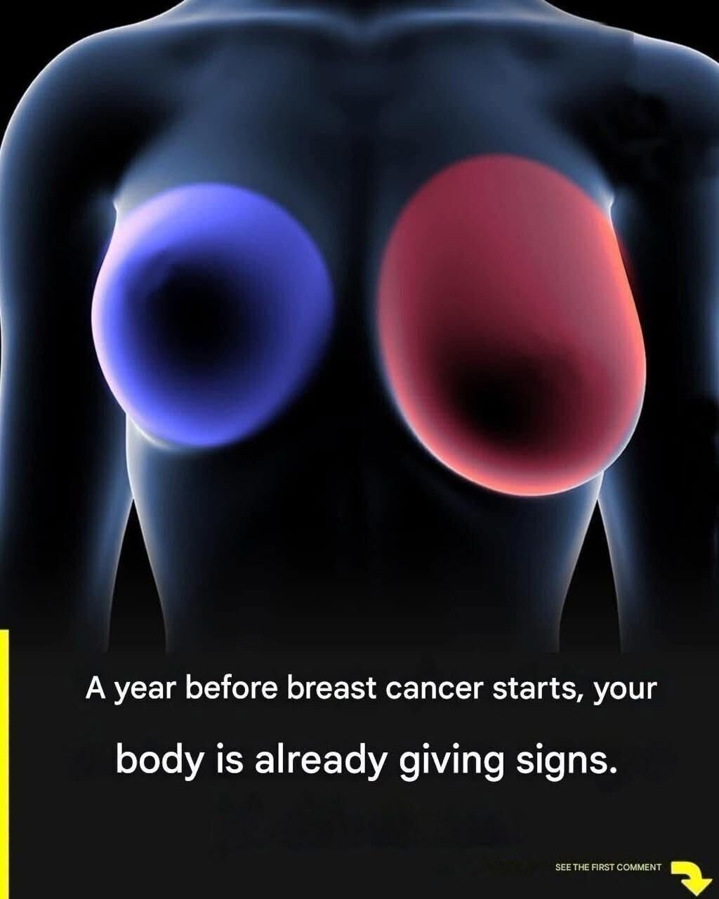 Breast Cancer Awareness: Four Early Warning Signs Every Woman Should Recognize, From Unusual Lumps and Changes in Breast Shape to Swelling in the Armpit and Persistent Pain — Understanding These Symptoms Early Can Save Lives Through Timely Detection and Proper Medical Evaluation