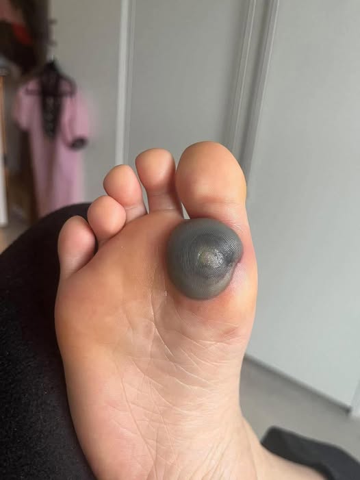 My daughter woke up with this huge spot on her foot I don’t know what it could be. She’s been in pain and can’t move her foot what is this.. Explain this 😩