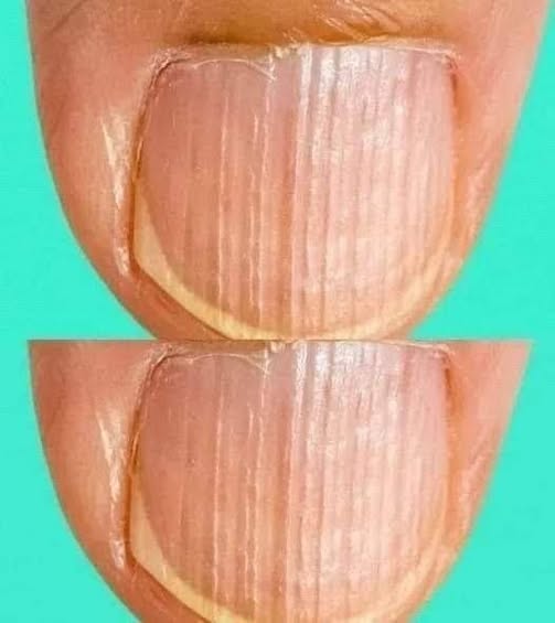What It Means When You Notice Ridges on Your Fingernails