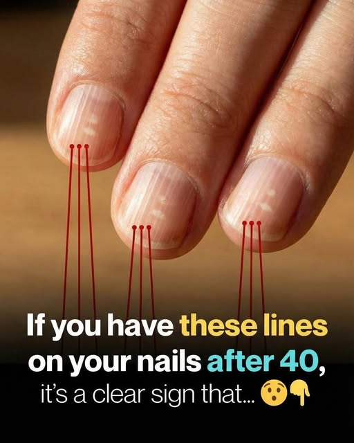 Why Vertical Lines on Your Nails Often Appear With Age