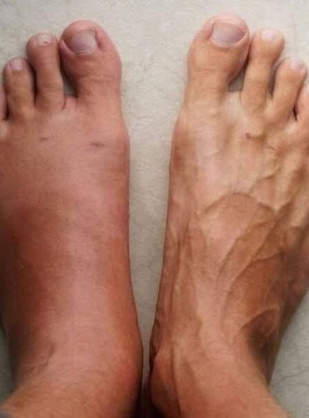 One Month Before a Heart Attack? What These 6 Symptoms Really Mean