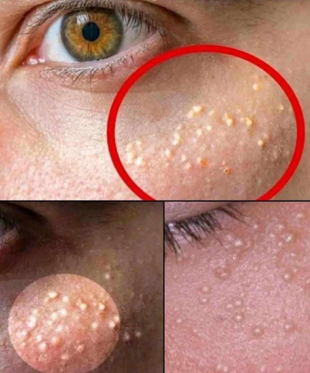 What Those Tiny White Bumps on Your Skin Really Mean