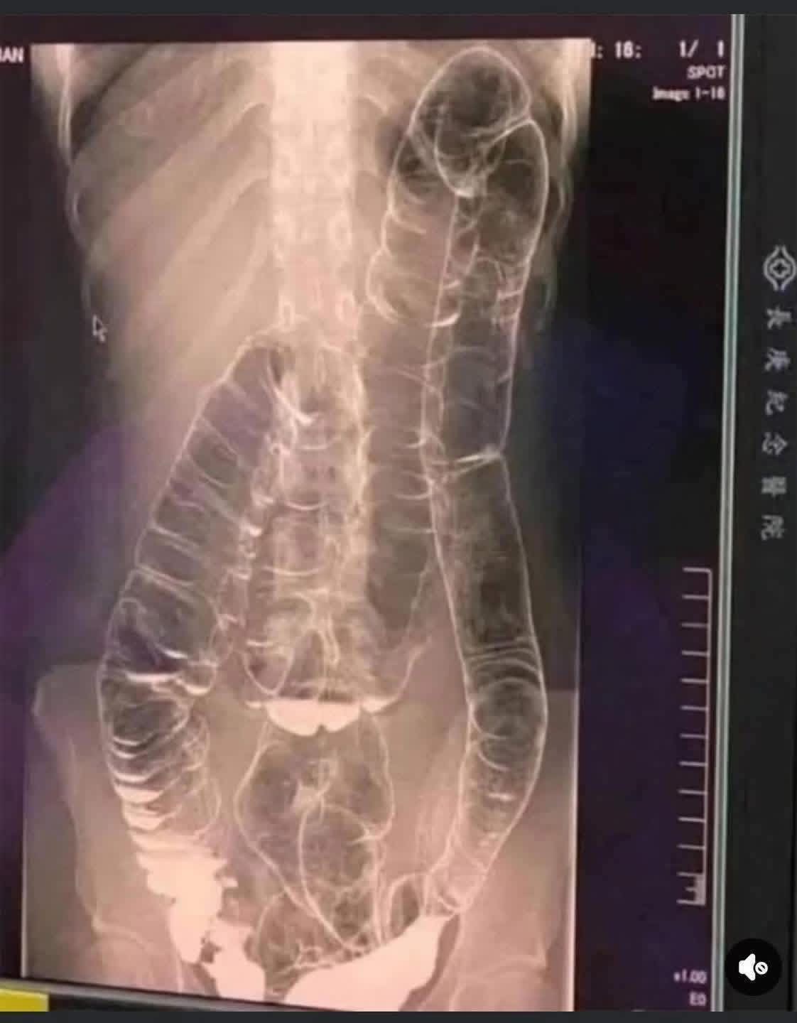 Severe Constipation and Toxic Megacolon: Causes and Solutions